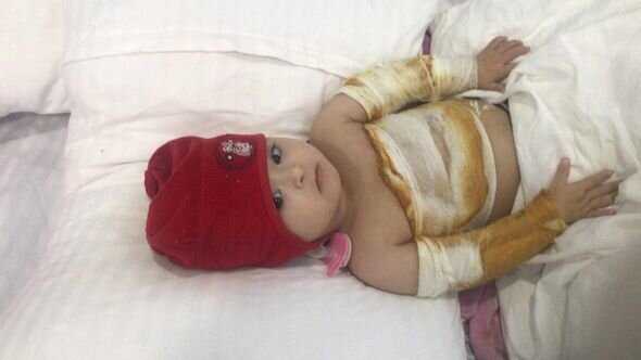 Bədəni yanan daun sindromlu körpənin anası: "Müalicəni etmək üçün imkanımız yoxdur" - FOTO