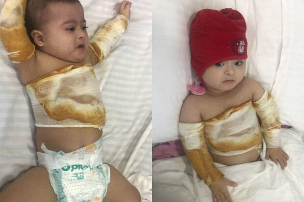 Bədəni yanan daun sindromlu körpənin anası: "Müalicəni etmək üçün imkanımız yoxdur" - FOTO