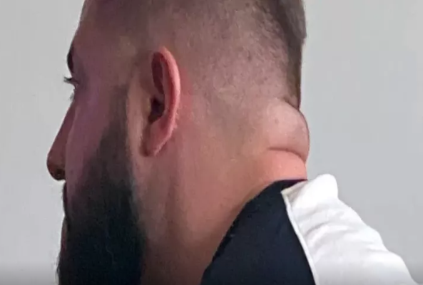 Boynunuzun qalın olması insult və diabet XƏBƏRDARLIĞIDIR