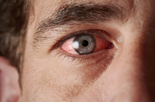 Yaşlı insanlarda gözlərin sulanmasının üç əsas SƏBƏBİ