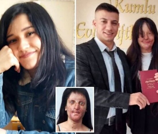 Sevgilisi qızın üzünə "kislota" atdı, sonra isə... - FOTO