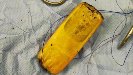 Həkimlər ŞOKDA: Mədəsindən TELEFON ÇIXDI - FOTO