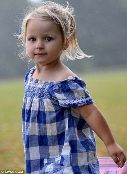 Bu qız "təlxək burnu" ilə doğulub - İllər sonrakı HALI - FOTO