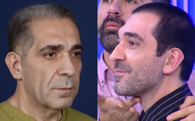 Nurlan Əzizbəyli plastik əməliyyatla üzünü dəyişdirdi - Fotolar