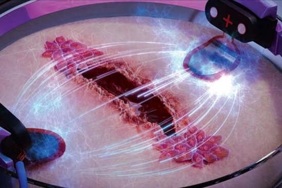 Elektrik cərəyanı yaraları üç dəfə tez sağaldır