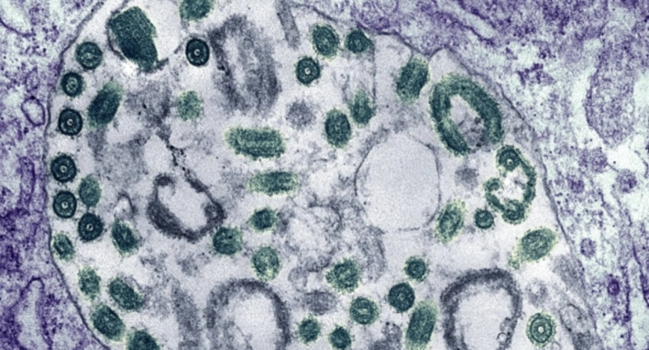 COVID keçirmiş insanlarda qan laxtalanır - Həkimdən xəbərdarlıq