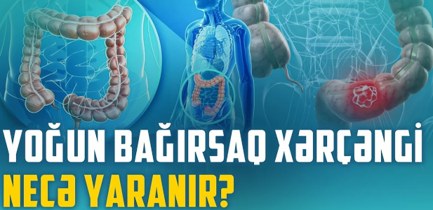 Yoğun bağırsaq xərçənginin qarşısını necə almaq olar? - VİDEO