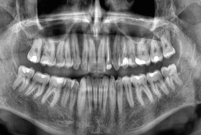 Diş itkisi ölüm riskini artıra bilər -ARAŞDIRMA