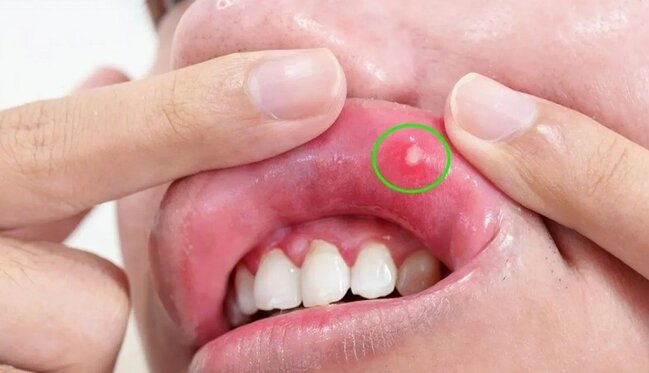 Xərçəngin gözə çarpmayan əlamətləri – DİQQƏTLİ OLUN!