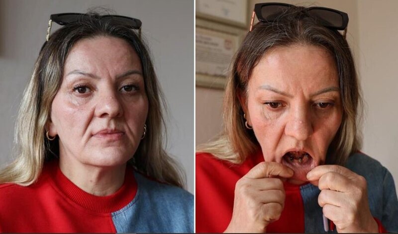 Diş ağrısı ilə getdi, 25 dişindən oldu