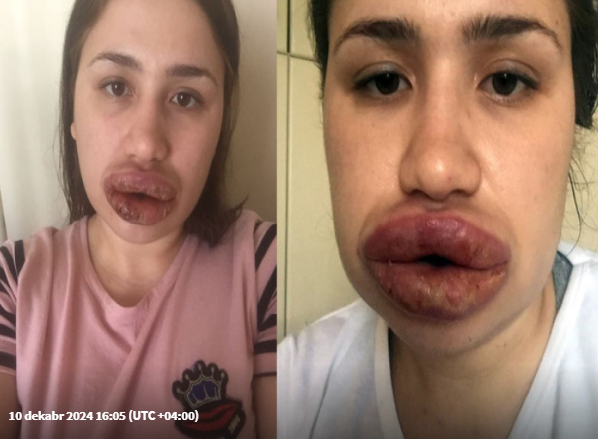 Ölümə aparan gözəllik: Süni dolğuların hansı fəsadları var? - ARAŞDIRMA