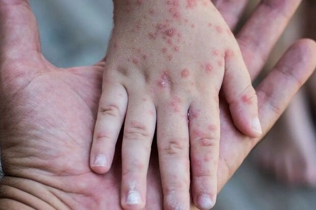 TƏBİB-dən qızılca ilə bağlı açıqlama: "Xəstələr qızılca əleyhinə peyvənd olunmamışlardır"