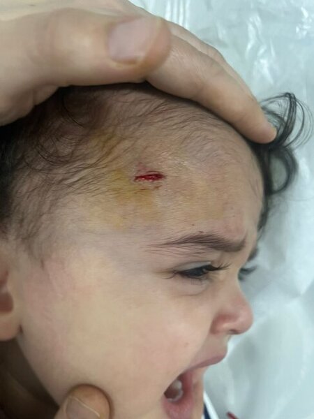 "Etimad KİDS" bağçasında uşağın başı yarıldı, ailəsinə xəbər verilmədi (FOTO)