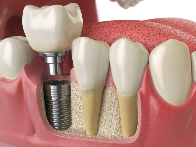 Cənubi Koreyada bir gündə 11 diş implantı qoyulan 75 yaşlı qadın öldü
