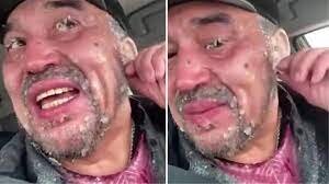 Dəhşət: Mənfi 50 dərəcə tədbir görməyən şəxs görün nə hala düşdü --VİDEO