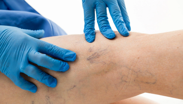 Damar xəstəlikləri nədən yaranır? - Arterial problemlər barədə bilinməyənlər