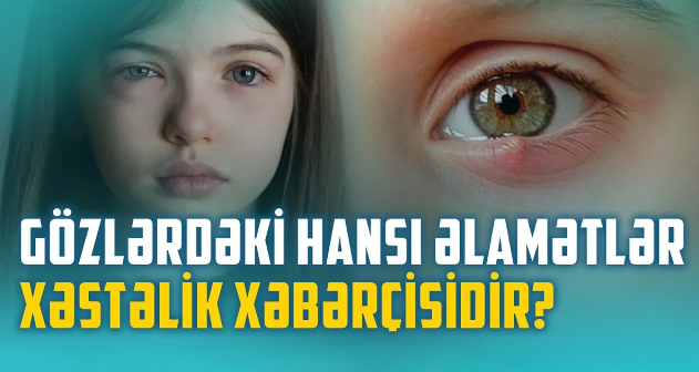 Gözlərimizin zəifləməməsi üçün nə etməli? - VİDEO