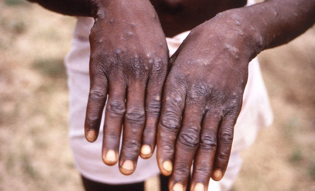 Syerra-Leonedə meymunçiçəyinin yeni dalğası: Ölənlər var