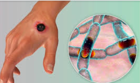 Azərbaycanda yayılan qarayaraya xəstəliyi nədir?- Açıqama