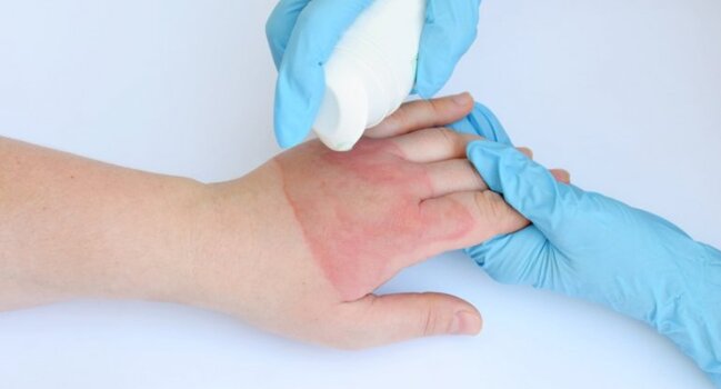 Uşaqlarda yanıq olan zaman valideynlərin yol verdiyi səhvlər - FOTO