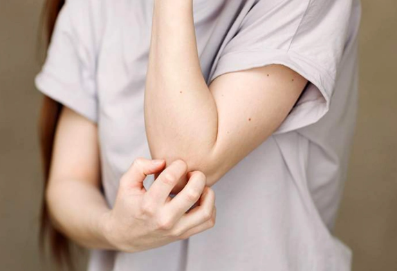 Britaniyada yüksək yolxucu epidemiya yayılır