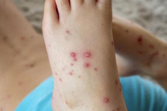 COVID-19 və meymunçiçəyi epidemiyası bitmədən yeni virus yayılır