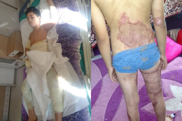 Bütün bədəni yanan 11 yaşlı Sabirin dəstəyə ehtiyacı var: Müalicə üçün pulları yoxdur - FOTO/VİDEO
