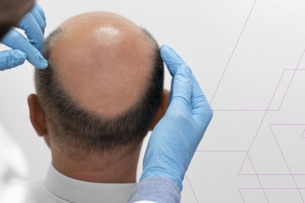 Keçəlliyə son qoymağın müasir yolu: Kimə saç əkdirmək olmaz? - ARAŞDIRMA