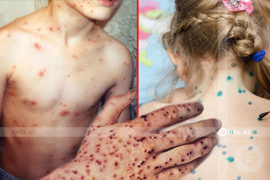 Meymun çiçəyinə görə karantin neçə gün olacaq?