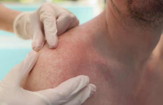 Yay aylarının gizli təhlükəsi: Günəş allergiyası barədə nə bilməliyik?