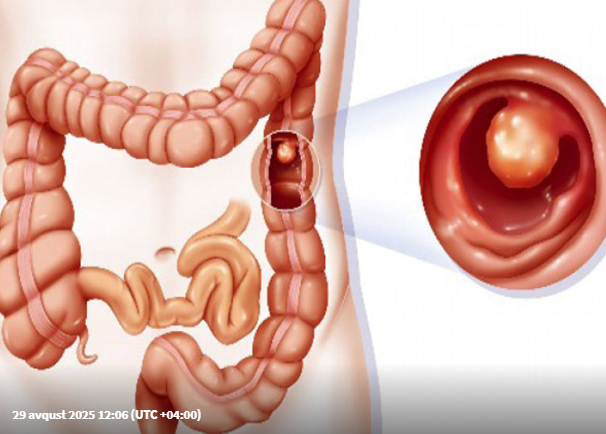 Həkimlərdən TÖVSİYƏ: bağırsaq xərçəngi riskini azaldan qaydalar