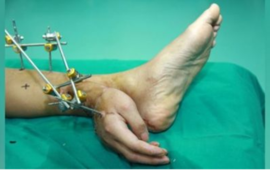 Qopmuş əlini ayağına tikib xilas etdilər - Unikal əməliyyat