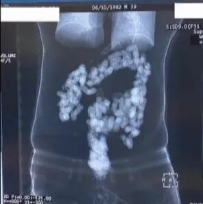 Mədələrindən 2 kilo heroin çıxdı - VİDEO