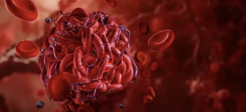 Tromb ola biləcəyini göstərən əsas narahatedici ƏLAMƏTLƏR