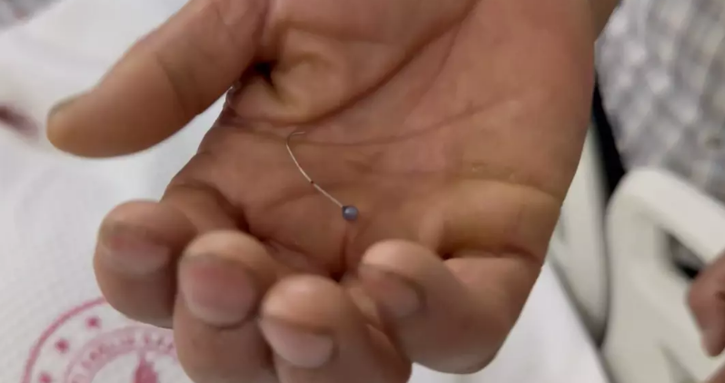 Çoxlu iynə udan 16 yaşlı qızın həyatı xilas edildi