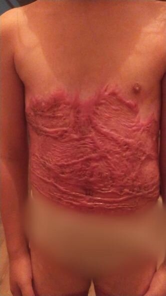 Yeddi yaşlı məktəbli qız ağır yanıq xəsarətləri alıb - FOTO