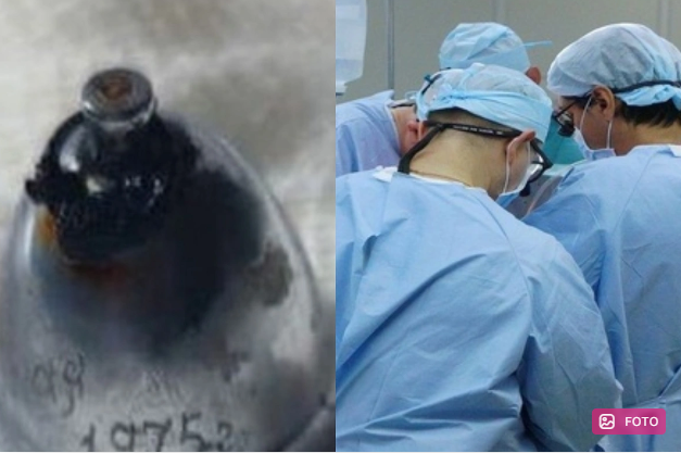 Rusiyada həkimlər ağciyərində metal zınqırov olan kişini xilas ediblər