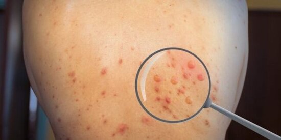 Meymunçiçəyi daha bir ölkəyə ÇATDI