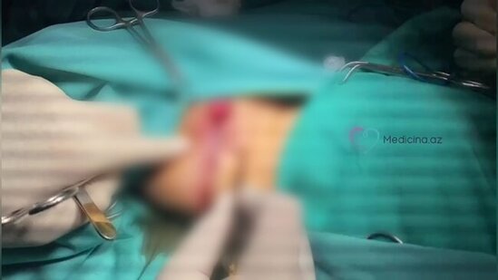 Bakıda kişi cinsiyyət orqanı ilə doğulan 10 yaşlı qız əməliyyat edildi - Anomal halın səbəbi