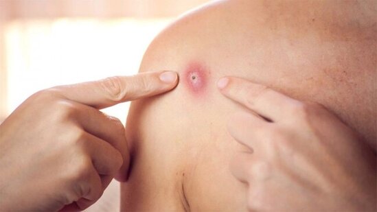 Meymunçiçəyi daha bir ölkəyə YAYILDI