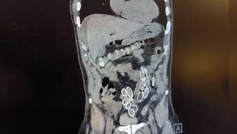 Mədə ağrısı ilə xəstəxanaya getdi, tomoqrafiyanı görən həkim dərhal polisə xəbər verdi