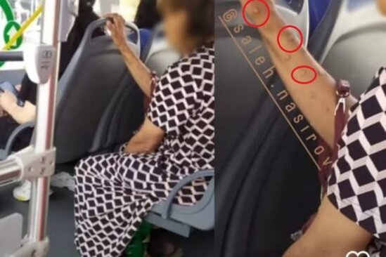 Meymunçiçəyi, yoxsa dəri xəstəliyi? - Həkim-dermatoveneroloqdan HƏYƏCAN TƏBİLİ + FOTO