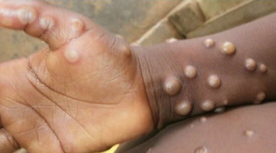 Avropada meymunçiçəyindən ilk ölüm