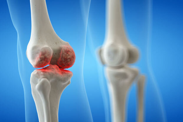 Diz-oynaq ağrılarında nəyə diqqət etməliyik? - VİDEO