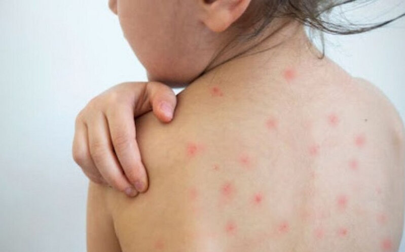 Pediatr qızılcadan qorunmağın yollarını açıqlayıb - FOTO