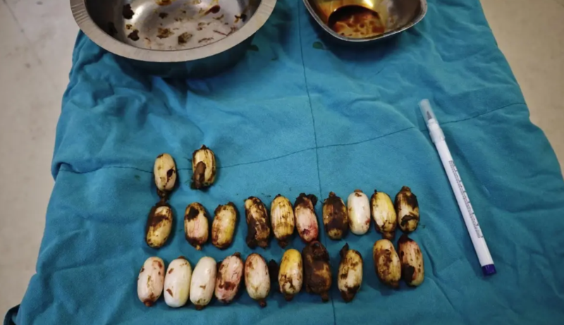 Polisin saxladığı şübhəlinin mədəsindən görün nələr çıxdı!