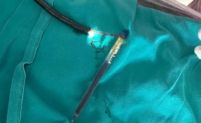 Gənc qadının mədəsindən iki ədəd qələm çıxarıldı - VİDEO