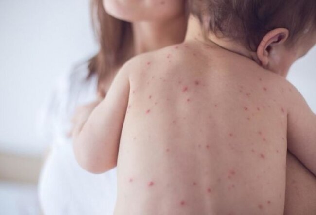 Valideynlərin DİQQƏTİNƏ: "Qızılcaya yoluxan bu uşaqların həyatı təhlükəsi daha çoxdur" - HƏKİM AÇIQLADI