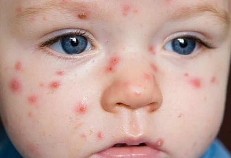 Azərbaycana qızılca ilə bağlı ilin sonunadək vaksinlər gətiriləcək