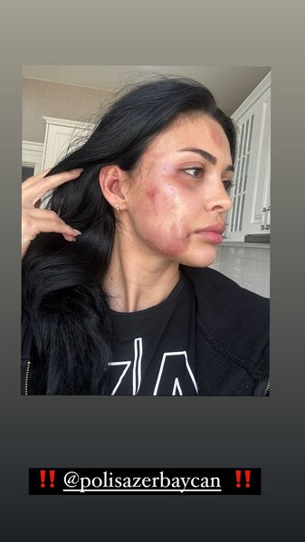 Azərbaycanlı model sevgilisi tərəfindən döyüldü - Foto